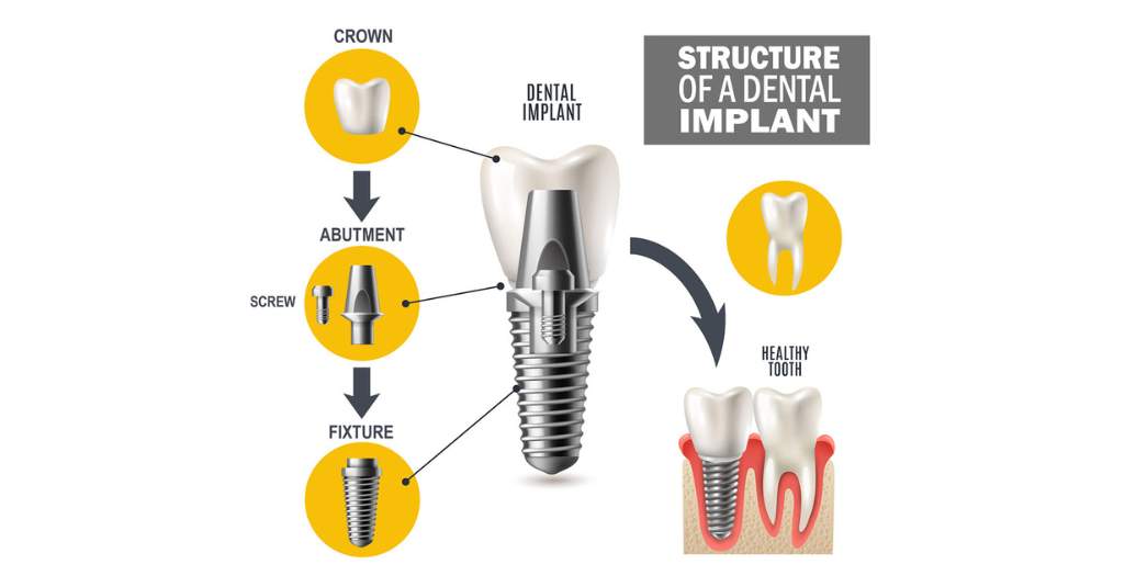 Dental implant in Turkey