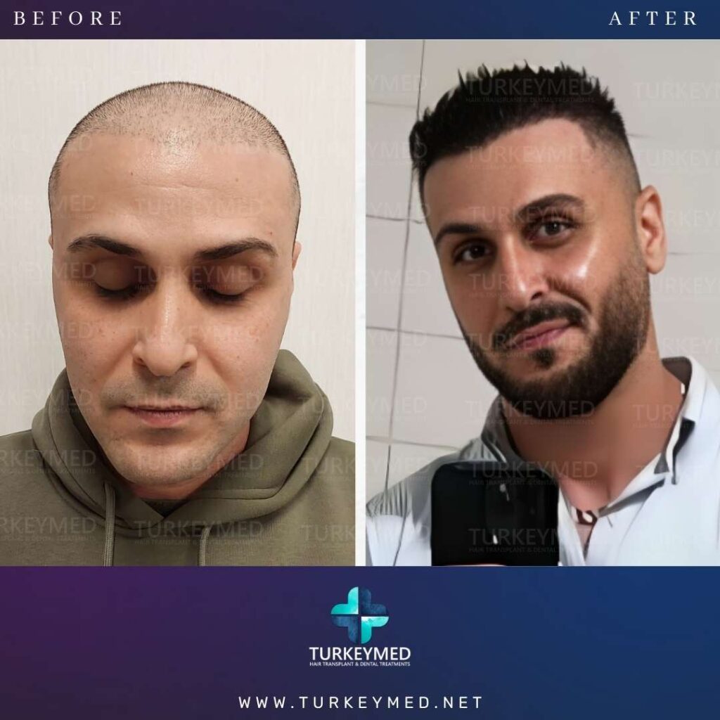 Before & After (2)