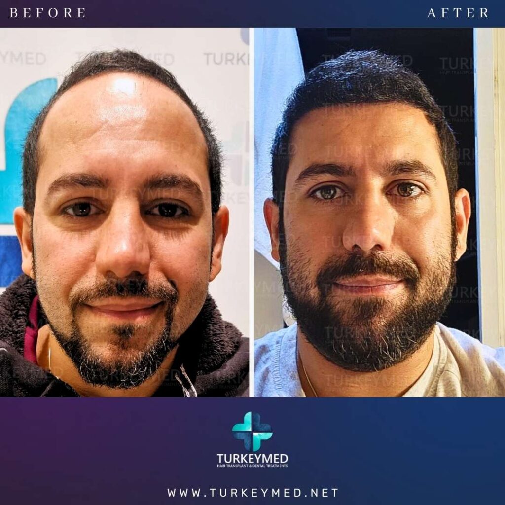 Before & After (5)