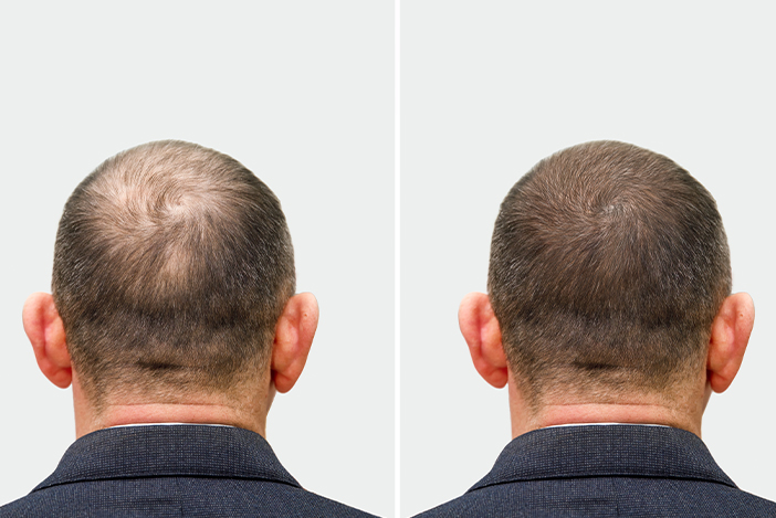 transferencia de cabello