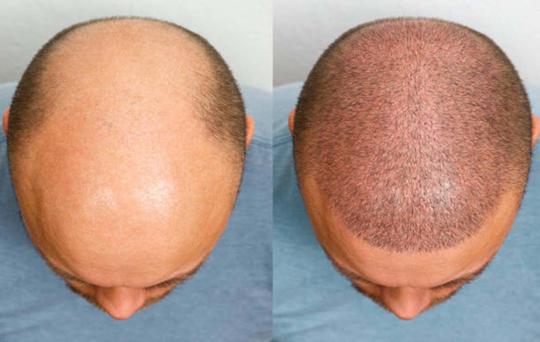 Trasplante de cabello