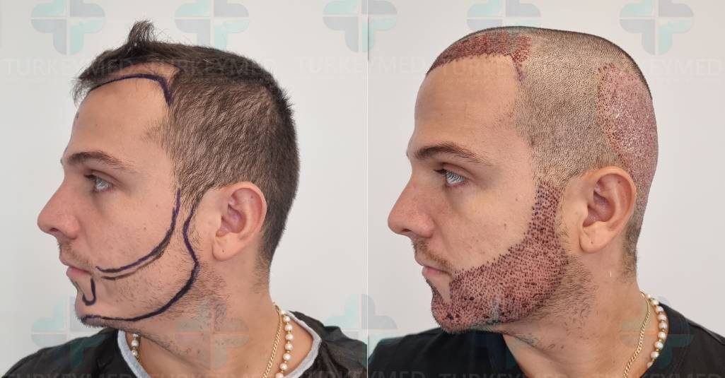 Beard Transplant in Turkeymed