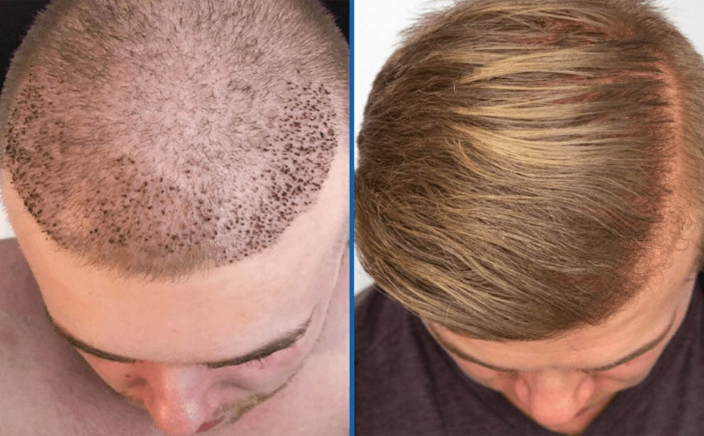 Hair Transplant