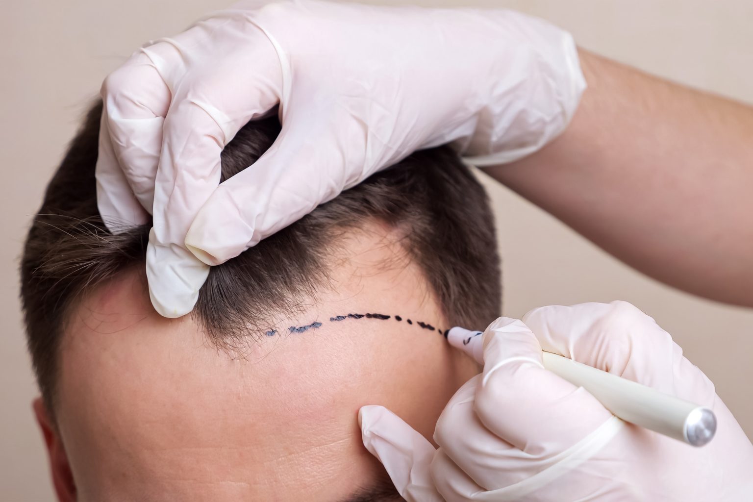 زراعة خط الشعر