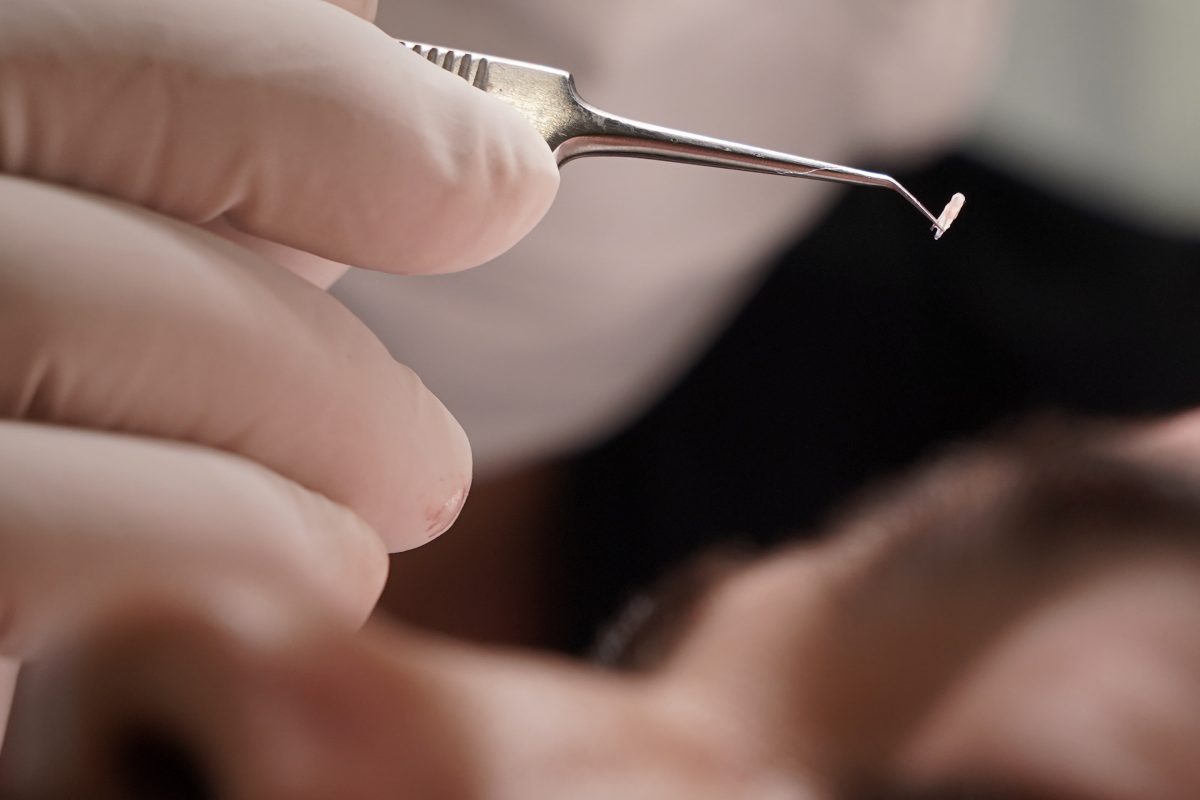 Hair Transplantation