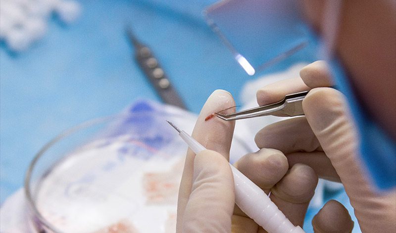 DHI Hair Transplant
