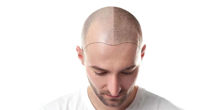 زراعة الشعر
