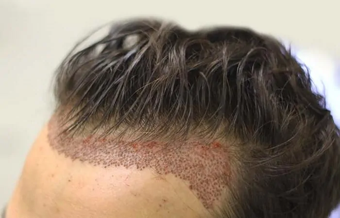 Trasplante de la Línea Frontal del Cabello