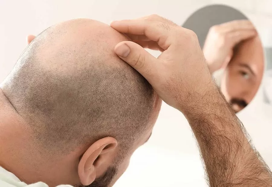 زراعة او نبات الشعر