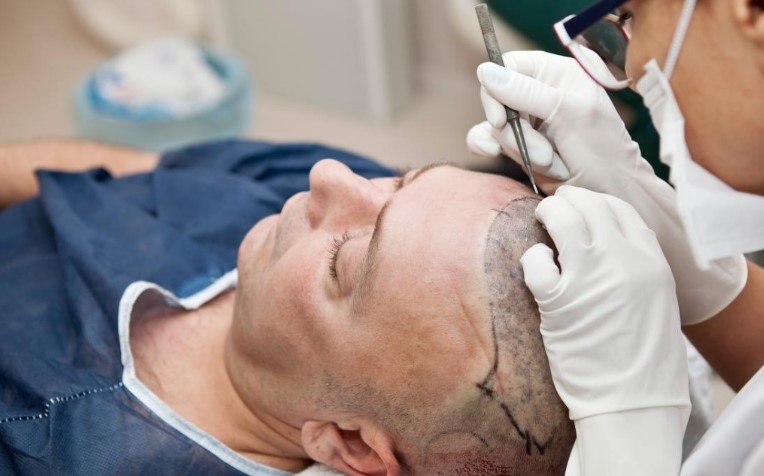 hair growth surgery
