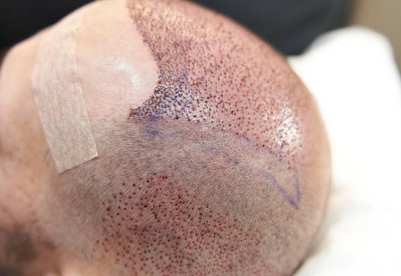 العناية بعد زراعة الشعر بتركيا