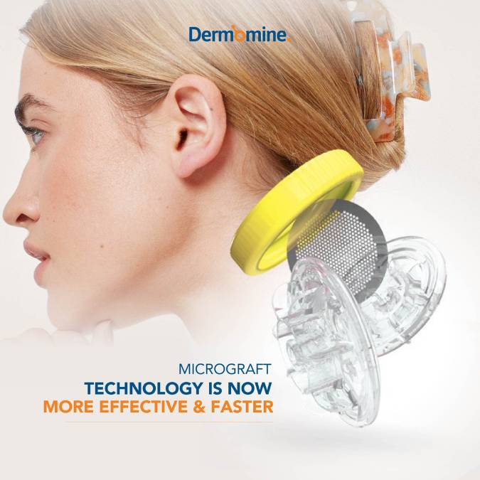 Células madre Micrograft Dermomine
