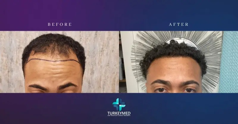 Résultats d'une greffe de cheveux